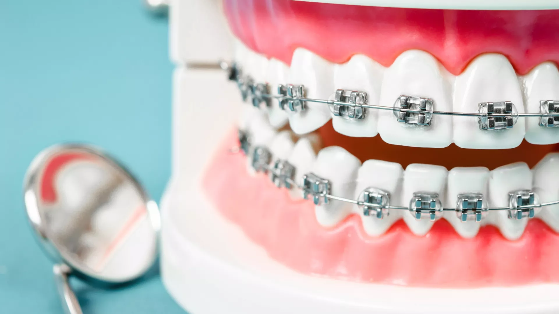 teeth with braces