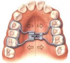 expander illustration