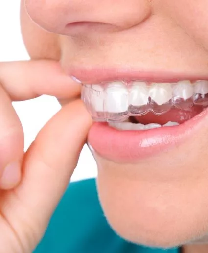 inserting clear aligner