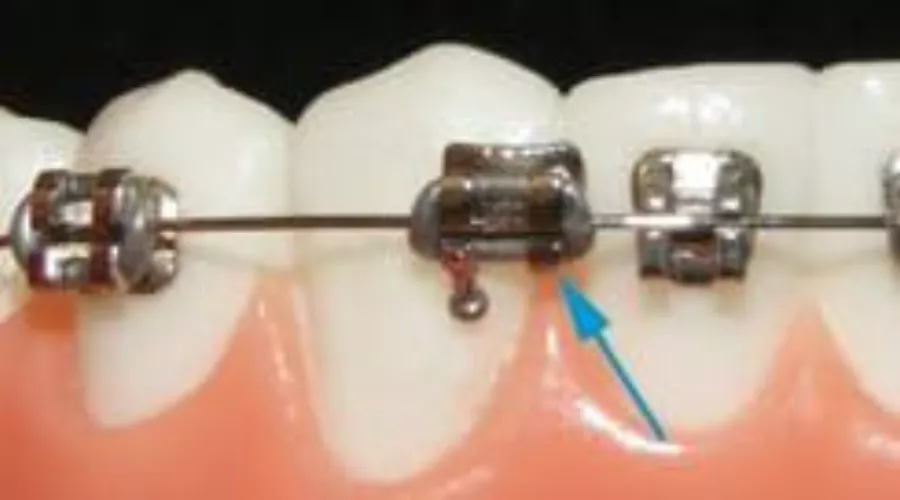 loose brackets