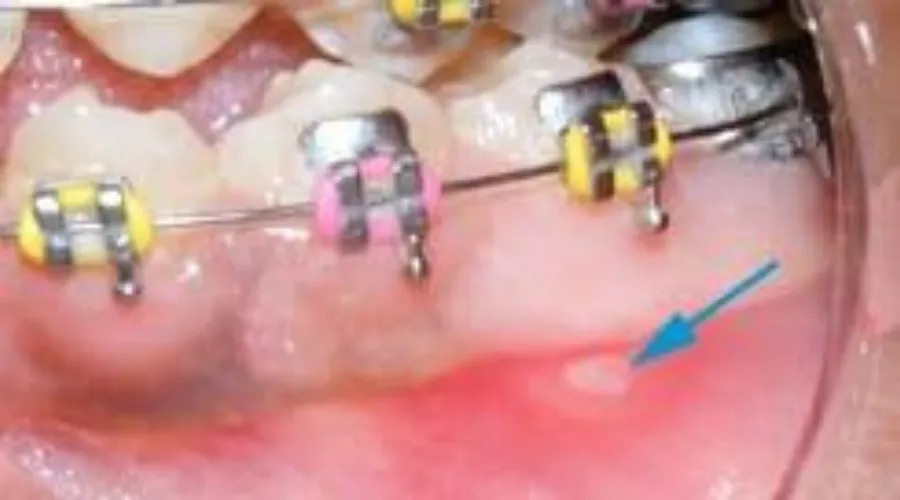 ulcers