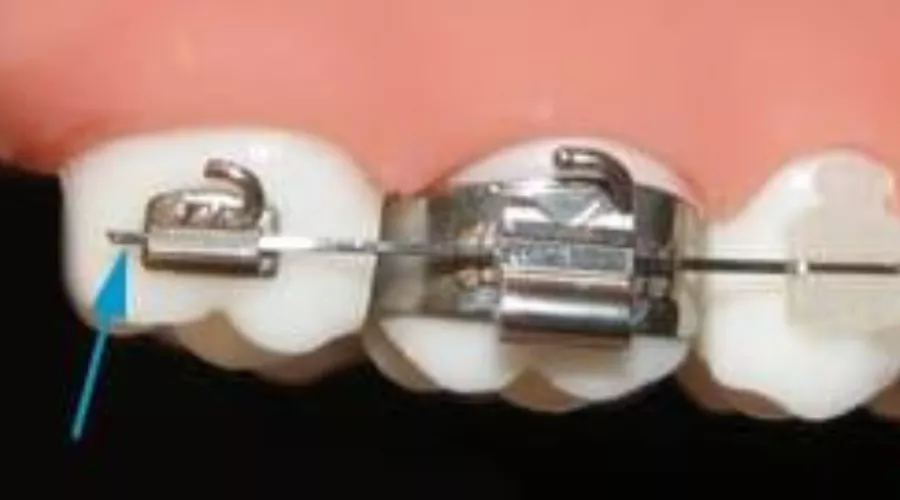 wire poking